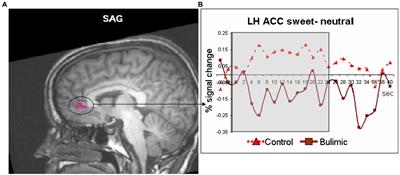 Brain activation in individuals suffering from bulimia nervosa and control subjects during sweet and sour taste stimuli